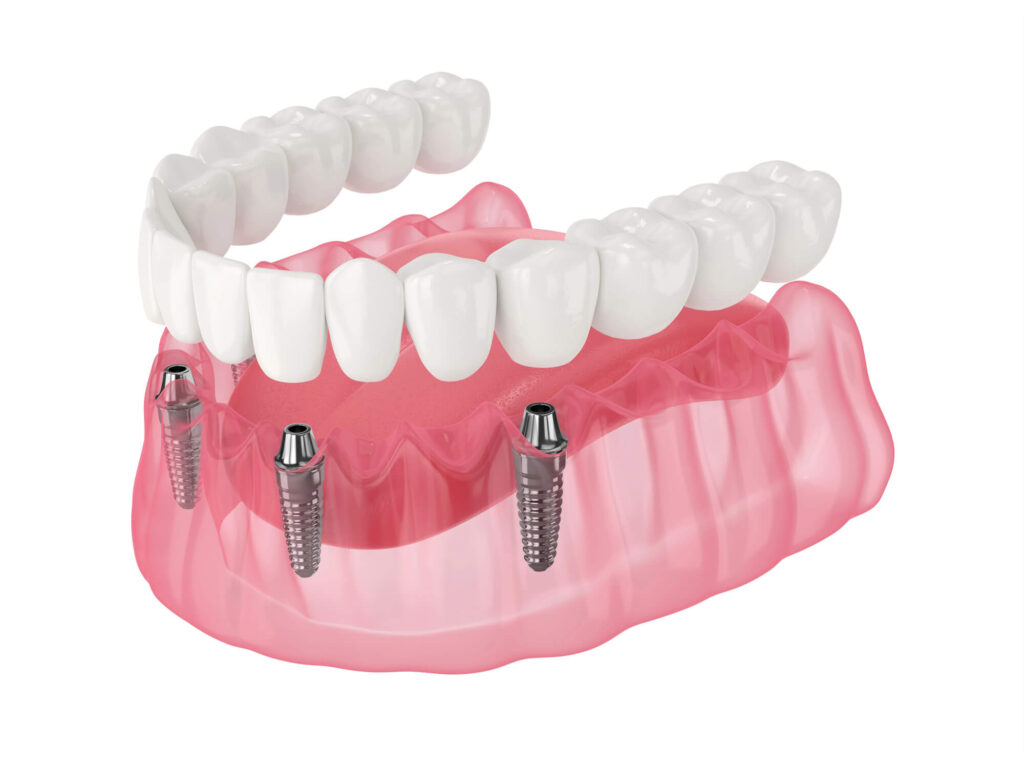 Medical illustration of a full-arch dental restoration supported by dental implants