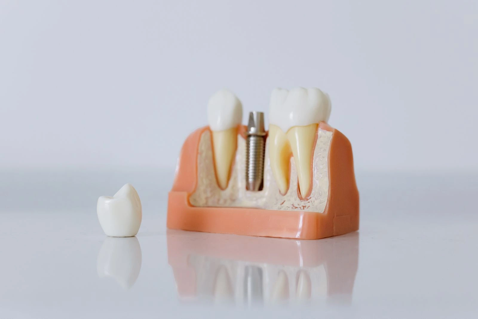 Educational dental model showing an implant in the jaw beside natural teeth, with a separate crown.