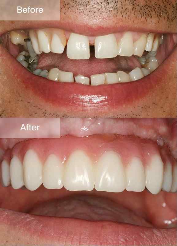 Original Maine Dentistry before-and-after smile comparison 1, with before above and after below
