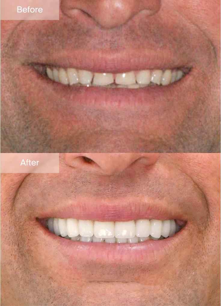 Original Maine Dentistry before-and-after smile comparison 2, with before above and after below