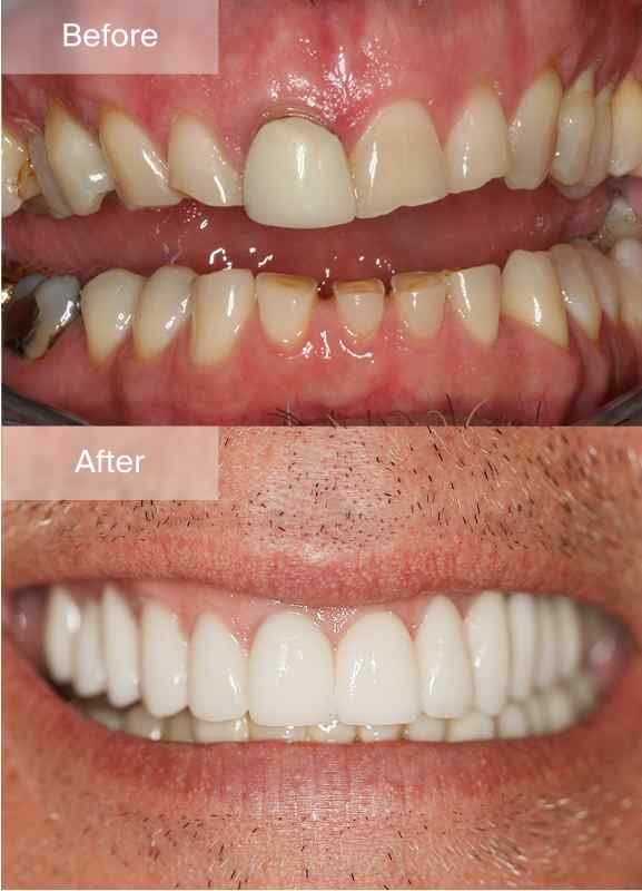 Original Maine Dentistry before-and-after smile comparison 3, with before above and after below