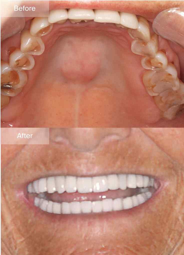 Original Maine Dentistry before-and-after smile comparison 4, with before above and after below