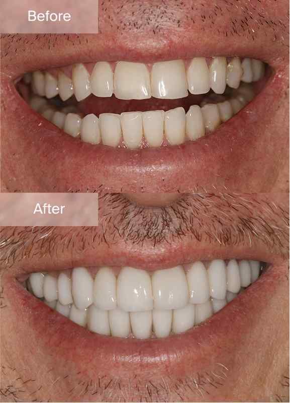 Original Maine Dentistry before-and-after smile comparison 5, with before above and after below